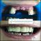 Riabilitazione frontale mista impianti ed elementi dentari